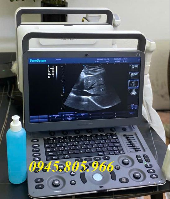 Top 7 máy siêu âm xách tay chất lượng, phân khúc giá dưới 100 triệu